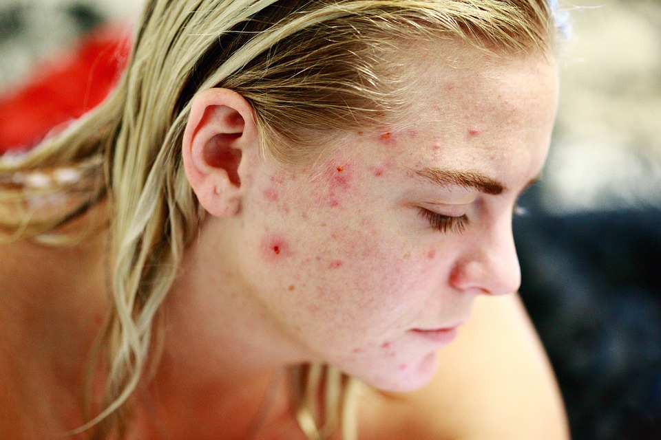 combattere-acne